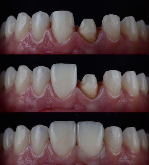 Dental Bonding - Dental Bonding Before And After Sacramento