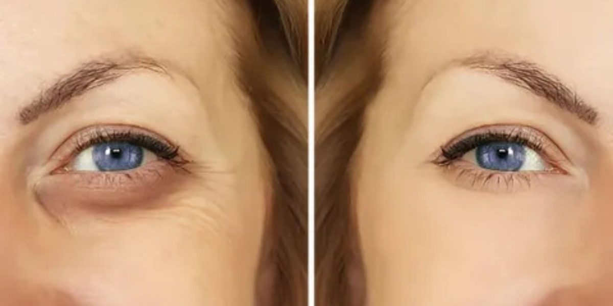 Rejuvenate Tired Eyes with Under Eye Fillers in Delhi at Sculpt India Clinic