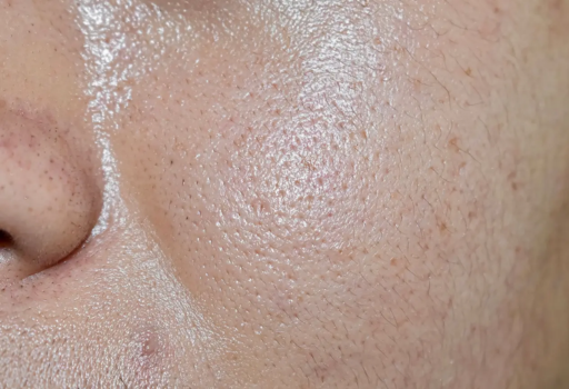 Caring for Oily Skin: Daily Tips for Healthy Skin