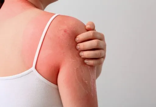 Photosensitivity: Causes, Symptoms, Treatment, and Prevention Tips